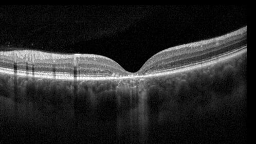 ABCA4 positive - Stargardt Disease
24 year old female She has worn glasses since she was a kid.  Since she became an adult her vision started to deteriorate more rapidly.  This seems to have been happening since she entered the accounting department for the last two years.  Her vision is worse in the light especially when she is driving.  She can see green lights in the night but not in the day.  She sees better on a dark background than on a light background. 
Her mother and father both have inherited retinal diseases.  His mother was diagnosed 23 years ago with Stargardts genetically confirmed in Boston.  The father has Retinitis Pigmentosa.  The mother has seven brothers and sisters and four have Stargardts and they are legally blind.  Also one cousin has it.

PMHx benign, Meds: vitamins.
VA OD: Dcc20/160
VA OS: Dcc20/160
IOP: TP: OD:20 OS:21

