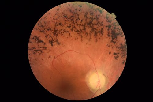 Retinitis Pigmentosa - Autosomal Dominant - Good Vision
55 year old female was diagnosed in 1990 with RP and the vision has been stable for the last 10 years.  Her mother and her two brothers and her grandmother and the patient and her two sisters all have confirmed RP.  No one has been tested. VA 20/25 OU
