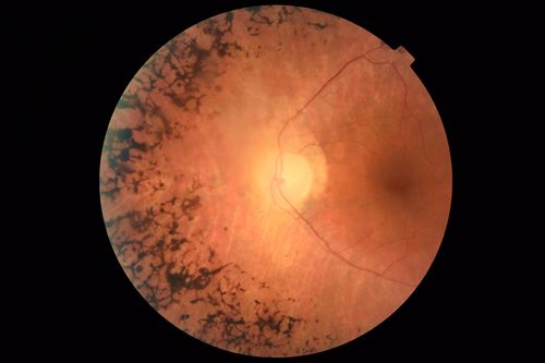 Retinitis Pigmentosa - Autosomal Dominant - Good Vision
55 year old female was diagnosed in 1990 with RP and the vision has been stable for the last 10 years.  Her mother and her two brothers and her grandmother and the patient and her two sisters all have confirmed RP.  No one has been tested. VA 20/25 OU
