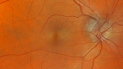 Ischemic Optic Neuropathy associated with GLP-1 Agonist
48 year old female woke up with blurry vision inferiorly in the right eye. the right optic nerve isnoted to be swollen. She does not have any pain with eye movements. The left eye is OK.
Medical History: Migraines
Surgical History: LASIK OU (2006) 
Systemic Meds: Mounjaro (tirzepatide) injection qweekly since 8/2024, Prozac, Nexium, Sumatriptan. 
VA OD: Dcc 20/20
VA OS: Dcc 20/16-1
