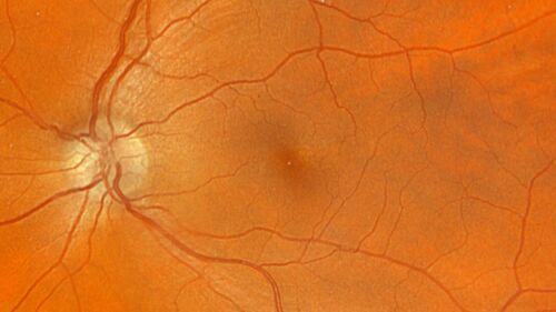 Ischemic Optic Neuropathy associated with GLP-1 Agonist
48 year old female woke up with blurry vision inferiorly in the right eye. the right optic nerve isnoted to be swollen. She does not have any pain with eye movements. The left eye is OK.
Medical History: Migraines
Surgical History: LASIK OU (2006) 
Systemic Meds: Mounjaro (tirzepatide) injection qweekly since 8/2024, Prozac, Nexium, Sumatriptan. 
VA OD: Dcc 20/20
VA OS: Dcc 20/16-1
