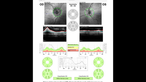 Ischemic Optic Neuropathy associated with GLP-1 Agonist
48 year old female woke up with blurry vision inferiorly in the right eye. the right optic nerve isnoted to be swollen. She does not have any pain with eye movements. The left eye is OK.
Medical History: Migraines
Surgical History: LASIK OU (2006) 
Systemic Meds: Mounjaro (tirzepatide) injection qweekly since 8/2024, Prozac, Nexium, Sumatriptan. 
VA OD: Dcc 20/20
VA OS: Dcc 20/16-1
