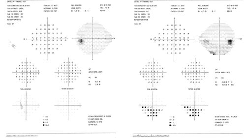 Ischemic Optic Neuropathy associated with GLP-1 Agonist
48 year old female woke up with blurry vision inferiorly in the right eye. the right optic nerve isnoted to be swollen. She does not have any pain with eye movements. The left eye is OK.
Medical History: Migraines
Surgical History: LASIK OU (2006) 
Systemic Meds: Mounjaro (tirzepatide) injection qweekly since 8/2024, Prozac, Nexium, Sumatriptan. 
VA OD: Dcc 20/20
VA OS: Dcc 20/16-1
