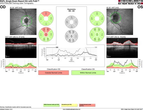 Acute AION OS - Mild disc pallor OD
Sudden vision loss OS x 1 week with optic nerve swelling.  Evidence of optic atrophy in right eye. 
