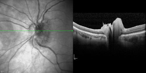 Acute AION OS - Mild disc pallor OD
Sudden vision loss OS x 1 week with optic nerve swelling.  Evidence of optic atrophy in right eye. 
