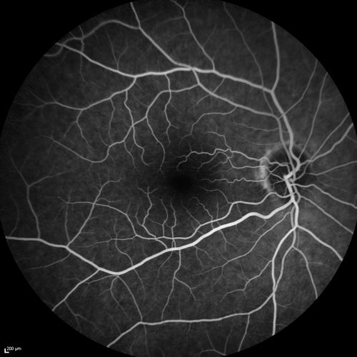 Acute AION OS - Mild disc pallor OD
Sudden vision loss OS x 1 week with optic nerve swelling.  Evidence of optic atrophy in right eye. 
