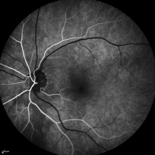 Acute AION OS - Mild disc pallor OD
Sudden vision loss OS x 1 week with optic nerve swelling.  Evidence of optic atrophy in right eye. 

