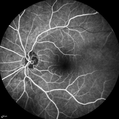 Acute AION OS - Mild disc pallor OD
Sudden vision loss OS x 1 week with optic nerve swelling.  Evidence of optic atrophy in right eye. 
