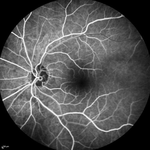 Acute AION OS - Mild disc pallor OD
Sudden vision loss OS x 1 week with optic nerve swelling.  Evidence of optic atrophy in right eye. 
