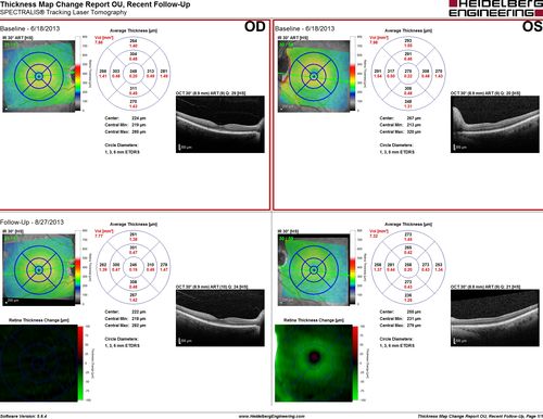 Acute AION OS - Mild disc pallor OD - macular scan shows increasing atrophy in left eye
