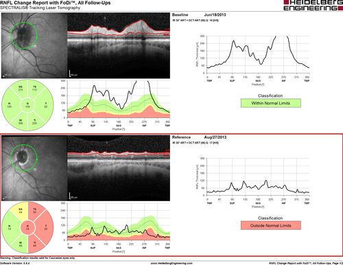 AION - Acute with Follow UP RNFL scan shows edema then atrophy
