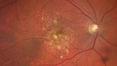 Focal Hyperpigmentation in Dry Age-Related Macular Degeneration
74 year old female with 20/32 vision right eye and 20/25 vision in the left eye.  Images show focal hyper-pigmentation which is a risk factor for progression to wet AMD
