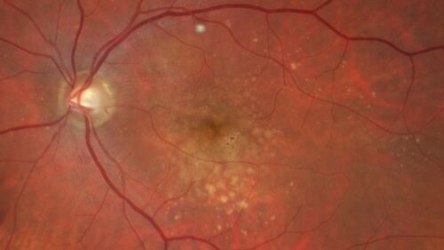 Focal Hyperpigmentation in Dry Age-Related Macular Degeneration
74 year old female with 20/32 vision right eye and 20/25 vision in the left eye.  Images show focal hyper-pigmentation which is a risk factor for progression to wet AMD
