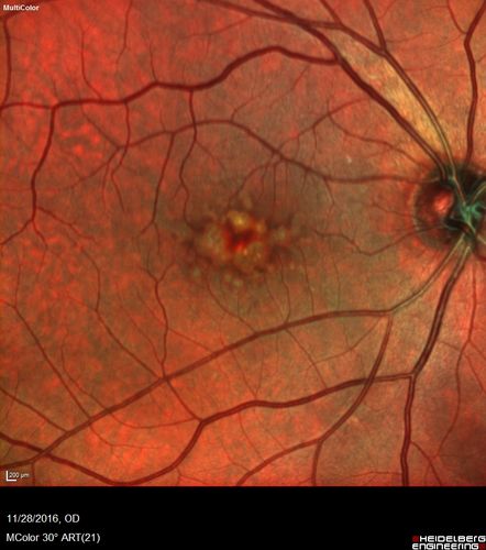 Confluent Soft Drusen with Subetinal Fluid - Right Eye
Asymptomatic 85 year old man.  OCT shows pocket of subfoveal fluid in the center of the macula.  This could be mechanical from the drusen preventing the retina from settling down.  Testing did not reveal a CNVM and subsequent OCT 6 weeks later showed no change in structure.
