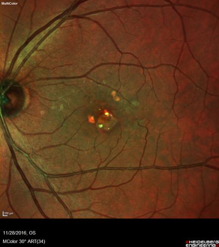 Confluent Soft Drusen with Subetinal Fluid - Right Eye
Asymptomatic 85 year old man.  OCT shows pocket of subfoveal fluid in the center of the macula.  This could be mechanical from the drusen preventing the retina from settling down.  Testing did not reveal a CNVM and subsequent OCT 6 weeks later showed no change in structure.
