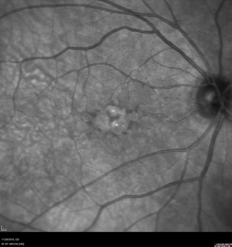 Confluent Soft Drusen with Subetinal Fluid - Right Eye
Asymptomatic 85 year old man.  OCT shows pocket of subfoveal fluid in the center of the macula.  This could be mechanical from the drusen preventing the retina from settling down.  Testing did not reveal a CNVM and subsequent OCT 6 weeks later showed no change in structure.
