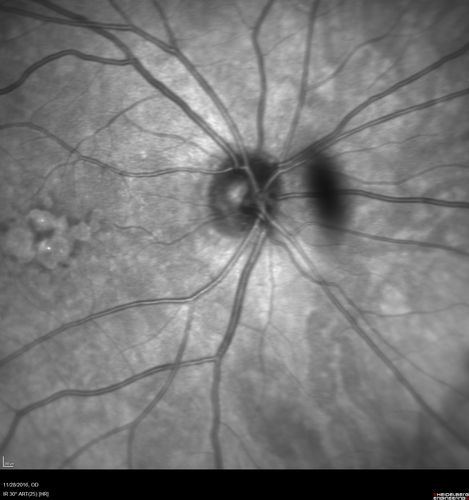 Confluent Soft Drusen with Subetinal Fluid - Right Eye
Asymptomatic 85 year old man.  OCT shows pocket of subfoveal fluid in the center of the macula.  This could be mechanical from the drusen preventing the retina from settling down.  Testing did not reveal a CNVM and subsequent OCT 6 weeks later showed no change in structure.
