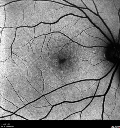Confluent Soft Drusen with Subetinal Fluid - Right Eye
Asymptomatic 85 year old man.  OCT shows pocket of subfoveal fluid in the center of the macula.  This could be mechanical from the drusen preventing the retina from settling down.  Testing did not reveal a CNVM and subsequent OCT 6 weeks later showed no change in structure.
