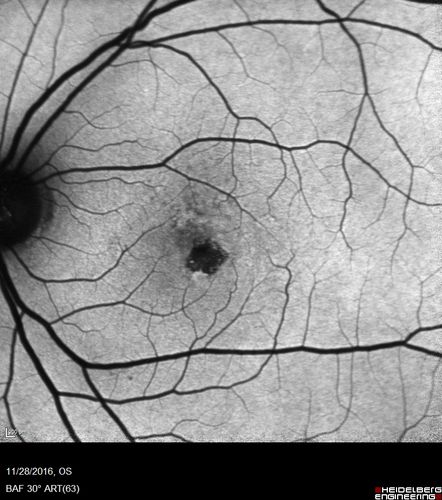 Confluent Soft Drusen with Subetinal Fluid - Right Eye
Asymptomatic 85 year old man.  OCT shows pocket of subfoveal fluid in the center of the macula.  This could be mechanical from the drusen preventing the retina from settling down.  Testing did not reveal a CNVM and subsequent OCT 6 weeks later showed no change in structure.
