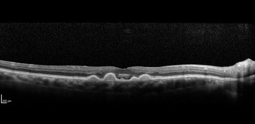 Confluent Soft Drusen with Subetinal Fluid - Right Eye
Asymptomatic 85 year old man.  OCT shows pocket of subfoveal fluid in the center of the macula.  This could be mechanical from the drusen preventing the retina from settling down.  Testing did not reveal a CNVM and subsequent OCT 6 weeks later showed no change in structure.
