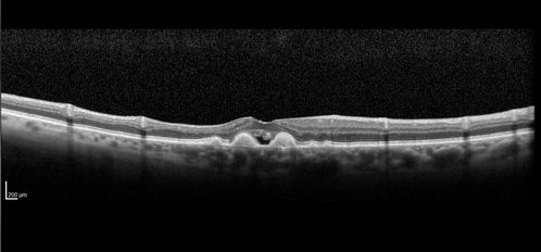 Confluent Soft Drusen with Subetinal Fluid - Right Eye
Asymptomatic 85 year old man.  OCT shows pocket of subfoveal fluid in the center of the macula.  This could be mechanical from the drusen preventing the retina from settling down.  Testing did not reveal a CNVM and subsequent OCT 6 weeks later showed no change in structure.
