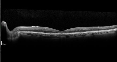 Confluent Soft Drusen with Subetinal Fluid - Right Eye
Asymptomatic 85 year old man.  OCT shows pocket of subfoveal fluid in the center of the macula.  This could be mechanical from the drusen preventing the retina from settling down.  Testing did not reveal a CNVM and subsequent OCT 6 weeks later showed no change in structure.
