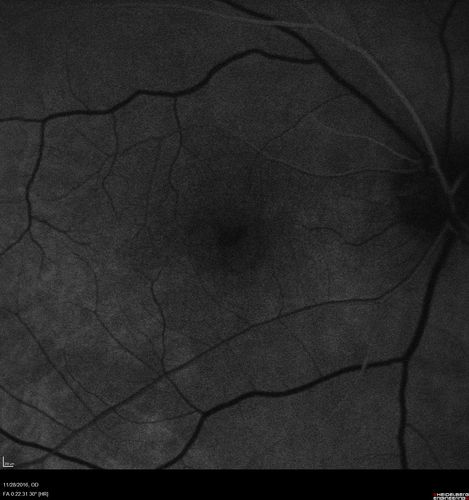 Confluent Soft Drusen with Subetinal Fluid - Right Eye
Asymptomatic 85 year old man.  OCT shows pocket of subfoveal fluid in the center of the macula.  This could be mechanical from the drusen preventing the retina from settling down.  Testing did not reveal a CNVM and subsequent OCT 6 weeks later showed no change in structure.
