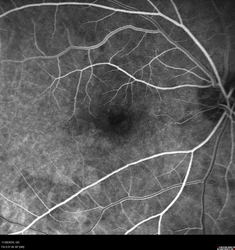Confluent Soft Drusen with Subetinal Fluid - Right Eye
Asymptomatic 85 year old man.  OCT shows pocket of subfoveal fluid in the center of the macula.  This could be mechanical from the drusen preventing the retina from settling down.  Testing did not reveal a CNVM and subsequent OCT 6 weeks later showed no change in structure.
