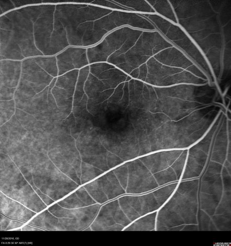 Confluent Soft Drusen with Subetinal Fluid - Right Eye
Asymptomatic 85 year old man.  OCT shows pocket of subfoveal fluid in the center of the macula.  This could be mechanical from the drusen preventing the retina from settling down.  Testing did not reveal a CNVM and subsequent OCT 6 weeks later showed no change in structure.
