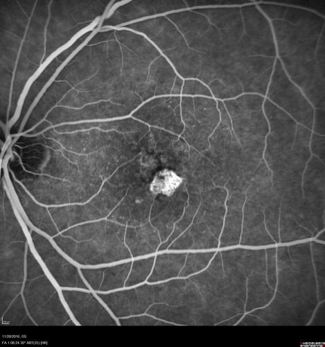 Confluent Soft Drusen with Subetinal Fluid - Right Eye
Asymptomatic 85 year old man.  OCT shows pocket of subfoveal fluid in the center of the macula.  This could be mechanical from the drusen preventing the retina from settling down.  Testing did not reveal a CNVM and subsequent OCT 6 weeks later showed no change in structure.
