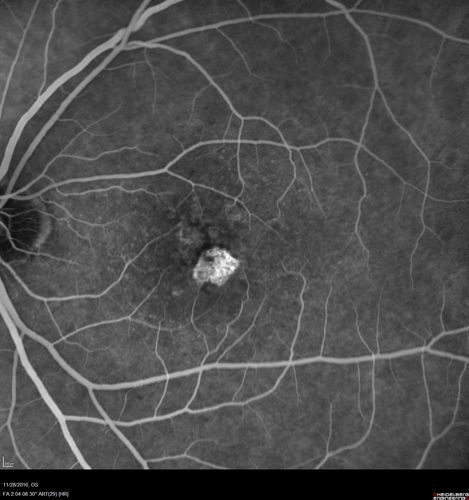 Confluent Soft Drusen with Subetinal Fluid - Right Eye
Asymptomatic 85 year old man.  OCT shows pocket of subfoveal fluid in the center of the macula.  This could be mechanical from the drusen preventing the retina from settling down.  Testing did not reveal a CNVM and subsequent OCT 6 weeks later showed no change in structure.

