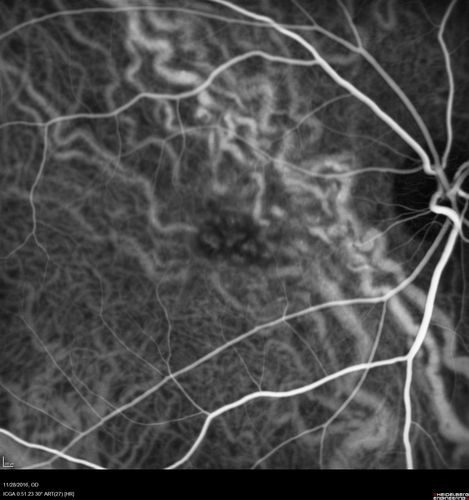 Confluent Soft Drusen with Subetinal Fluid - Right Eye
Asymptomatic 85 year old man.  OCT shows pocket of subfoveal fluid in the center of the macula.  This could be mechanical from the drusen preventing the retina from settling down.  Testing did not reveal a CNVM and subsequent OCT 6 weeks later showed no change in structure.
