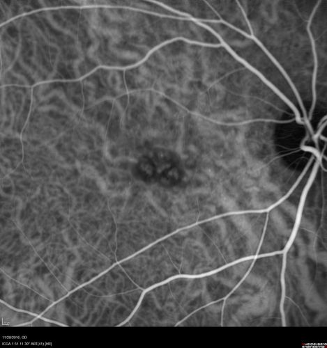 Confluent Soft Drusen with Subetinal Fluid - Right Eye
Asymptomatic 85 year old man.  OCT shows pocket of subfoveal fluid in the center of the macula.  This could be mechanical from the drusen preventing the retina from settling down.  Testing did not reveal a CNVM and subsequent OCT 6 weeks later showed no change in structure.
