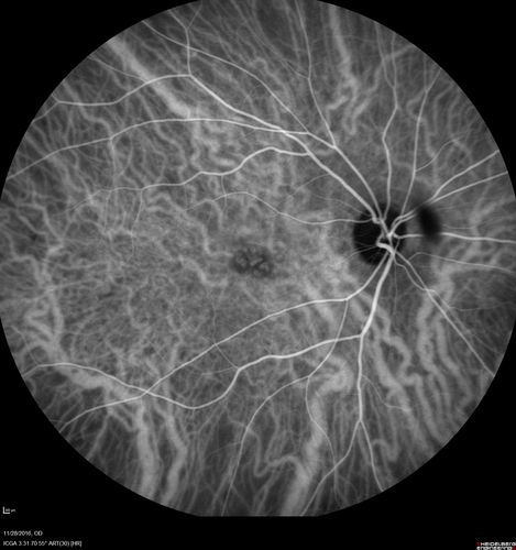 Confluent Soft Drusen with Subetinal Fluid - Right Eye
Asymptomatic 85 year old man.  OCT shows pocket of subfoveal fluid in the center of the macula.  This could be mechanical from the drusen preventing the retina from settling down.  Testing did not reveal a CNVM and subsequent OCT 6 weeks later showed no change in structure.

