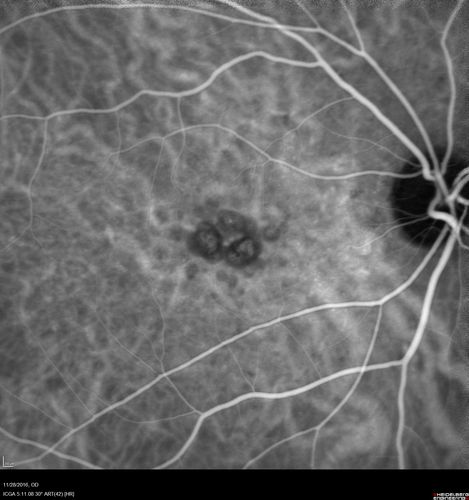 Confluent Soft Drusen with Subetinal Fluid - Right Eye
Asymptomatic 85 year old man.  OCT shows pocket of subfoveal fluid in the center of the macula.  This could be mechanical from the drusen preventing the retina from settling down.  Testing did not reveal a CNVM and subsequent OCT 6 weeks later showed no change in structure.
