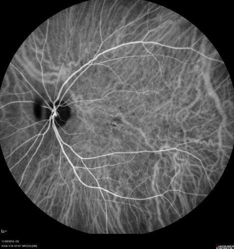 Confluent Soft Drusen with Subetinal Fluid - Right Eye
Asymptomatic 85 year old man.  OCT shows pocket of subfoveal fluid in the center of the macula.  This could be mechanical from the drusen preventing the retina from settling down.  Testing did not reveal a CNVM and subsequent OCT 6 weeks later showed no change in structure.
