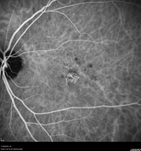 Confluent Soft Drusen with Subetinal Fluid - Right Eye
Asymptomatic 85 year old man.  OCT shows pocket of subfoveal fluid in the center of the macula.  This could be mechanical from the drusen preventing the retina from settling down.  Testing did not reveal a CNVM and subsequent OCT 6 weeks later showed no change in structure.
