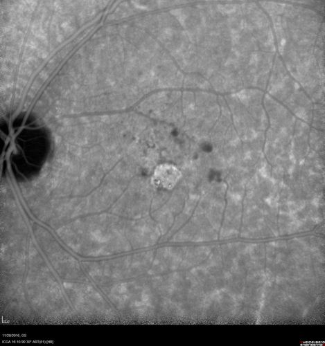 Confluent Soft Drusen with Subetinal Fluid - Right Eye
Asymptomatic 85 year old man.  OCT shows pocket of subfoveal fluid in the center of the macula.  This could be mechanical from the drusen preventing the retina from settling down.  Testing did not reveal a CNVM and subsequent OCT 6 weeks later showed no change in structure.
