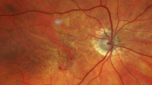 wet AMD with classic extrafoveal macular neovascularization in the good eye
89 year old man with longstanding vision loss in the left eye presented with one month of mild vision loss in the right eye.  Vision was 20/32.  This eye responded to vabysmo therapy.
