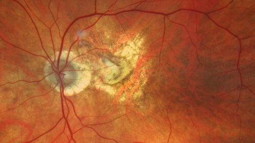 wet AMD with classic extrafoveal macular neovascularization in the good eye
89 year old man with longstanding vision loss in the left eye presented with one month of mild vision loss in the right eye.  Vision was 20/32.  This eye responded to vabysmo therapy.
