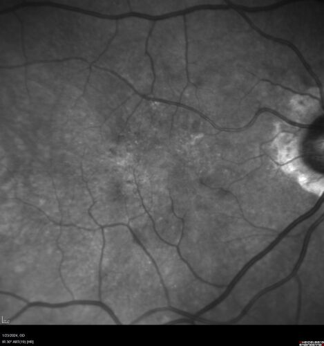 wet AMD with classic extrafoveal macular neovascularization in the good eye
89 year old man with longstanding vision loss in the left eye presented with one month of mild vision loss in the right eye.  Vision was 20/32.  This eye responded to vabysmo therapy.
