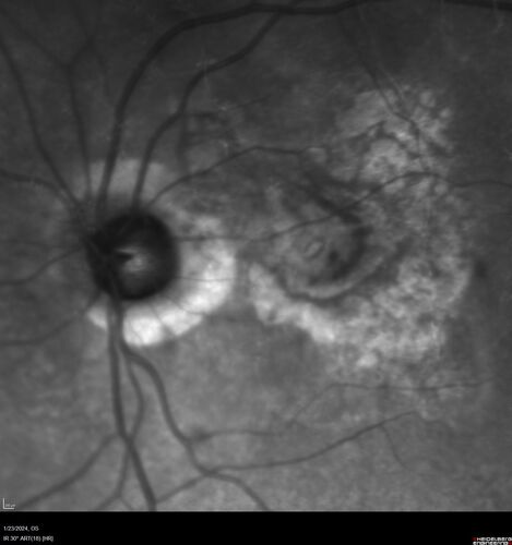 wet AMD with classic extrafoveal macular neovascularization in the good eye
89 year old man with longstanding vision loss in the left eye presented with one month of mild vision loss in the right eye.  Vision was 20/32.  This eye responded to vabysmo therapy.
