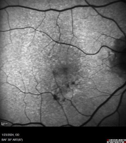 wet AMD with classic extrafoveal macular neovascularization in the good eye
89 year old man with longstanding vision loss in the left eye presented with one month of mild vision loss in the right eye.  Vision was 20/32.  This eye responded to vabysmo therapy.
