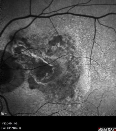 wet AMD with classic extrafoveal macular neovascularization in the good eye
89 year old man with longstanding vision loss in the left eye presented with one month of mild vision loss in the right eye.  Vision was 20/32.  This eye responded to vabysmo therapy.
