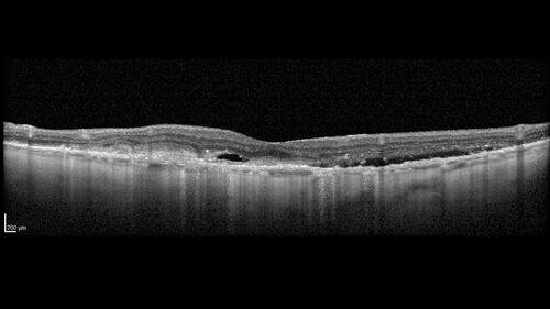 wet AMD with classic extrafoveal macular neovascularization in the good eye
89 year old man with longstanding vision loss in the left eye presented with one month of mild vision loss in the right eye.  Vision was 20/32.  This eye responded to vabysmo therapy.
