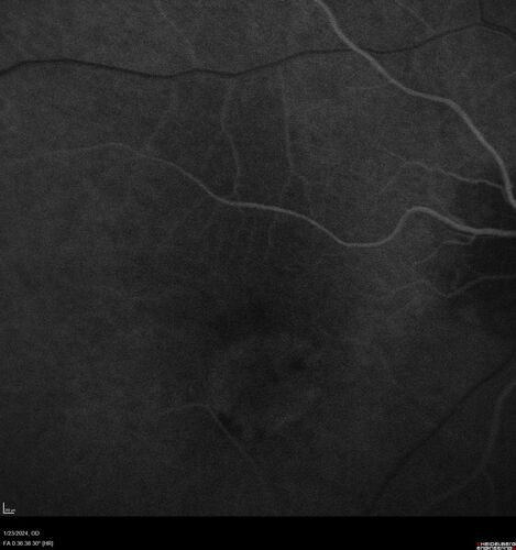 wet AMD with classic extrafoveal macular neovascularization in the good eye
89 year old man with longstanding vision loss in the left eye presented with one month of mild vision loss in the right eye.  Vision was 20/32.  This eye responded to vabysmo therapy.
