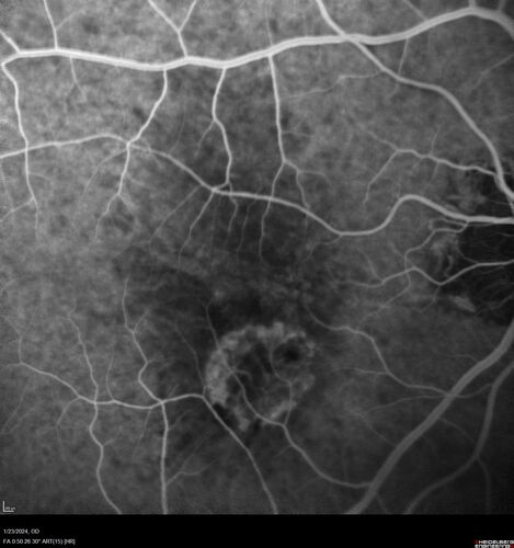 wet AMD with classic extrafoveal macular neovascularization in the good eye
89 year old man with longstanding vision loss in the left eye presented with one month of mild vision loss in the right eye.  Vision was 20/32.  This eye responded to vabysmo therapy.
