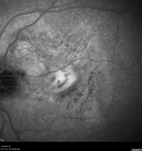 wet AMD with classic extrafoveal macular neovascularization in the good eye
89 year old man with longstanding vision loss in the left eye presented with one month of mild vision loss in the right eye.  Vision was 20/32.  This eye responded to vabysmo therapy.

