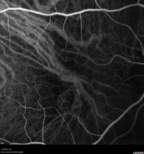wet AMD with classic extrafoveal macular neovascularization in the good eye
89 year old man with longstanding vision loss in the left eye presented with one month of mild vision loss in the right eye.  Vision was 20/32.  This eye responded to vabysmo therapy.
