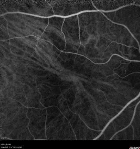 wet AMD with classic extrafoveal macular neovascularization in the good eye
89 year old man with longstanding vision loss in the left eye presented with one month of mild vision loss in the right eye.  Vision was 20/32.  This eye responded to vabysmo therapy.
